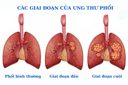 Ung thư phổi giai đoạn 1 và giải pháp ngăn chặn nhờ Tumolung