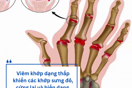 Viêm khớp dạng thấp: Nguyên nhân và giải pháp cải thiện từ Hoàng Thấp Linh