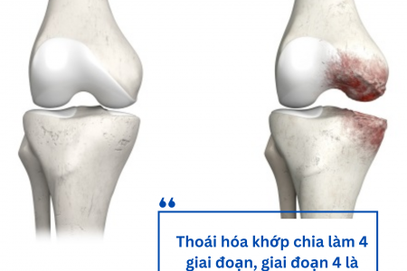 4 Giai đoạn của thoái hóa khớp và giải pháp từ CốtWells chứa màng vỏ trứng