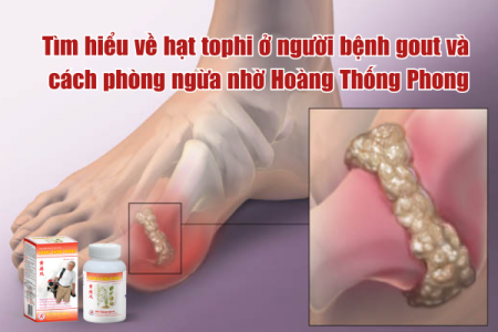 Tìm hiểu về hạt tophi ở người bệnh gout và cách phòng ngừa nhờ Hoàng Thống Phong