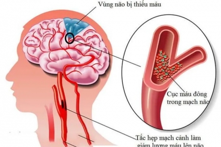 Ai dễ bị thiếu máu não?