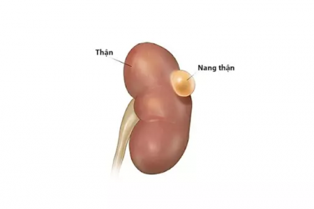 Giải pháp hữu hiệu cho người bị nang thận trái từ Ích Thận Vương