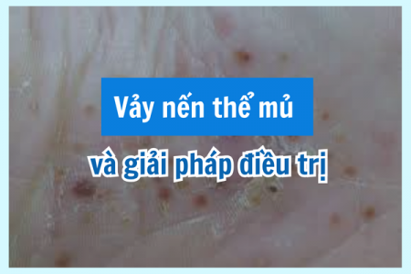 Vảy nến thể mủ và giải pháp hỗ trợ giảm triệu chứng an toàn, ngừa tái phát với Kim Miễn Khang