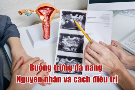 Buồng trứng đa nang - Nguyên nhân và cách điều trị