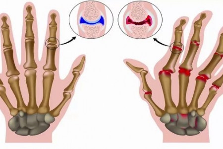 Giải pháp giảm đau khớp từ thảo dược - Bách Thống Vương