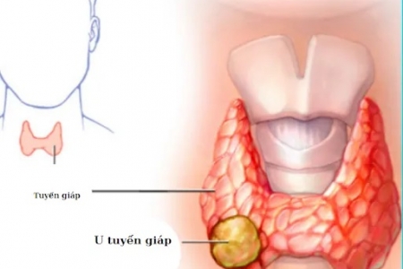 Nhân tuyến giáp tirads 3 và cách điều trị bệnh hiệu quả, tránh phải mổ