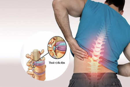 4 giai đoạn thoát vị đĩa đệm và giải pháp cải thiện hiệu quả từ Cốt Thoái Vương