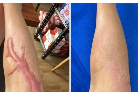 Nhiều khách hàng bức xúc Viện thẩm mỹ Emprie Lạng Sơn (Viện sắc đẹp Emprie)