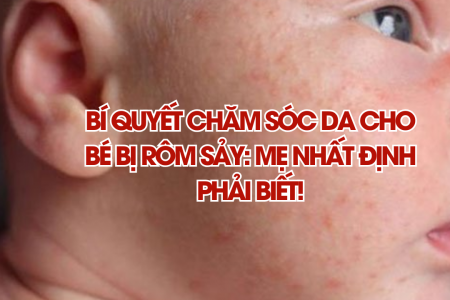 Bí quyết chăm sóc da cho bé bị rôm sảy: Mẹ nhất định phải biết!