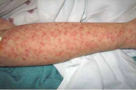 WHO cảnh báo virus Chikungunya có thể gây sốt cao, đau khớp