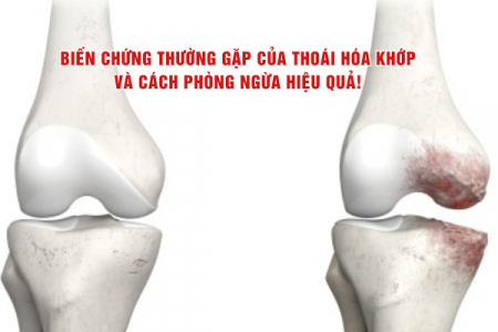 Biến chứng thường gặp của thoái hóa khớp và cách phòng ngừa hiệu quả!