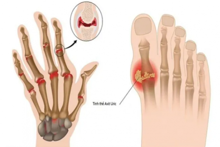 Cảnh báo nồng độ axit uric cao: Đừng chủ quan với 7 dấu hiệu âm thầm