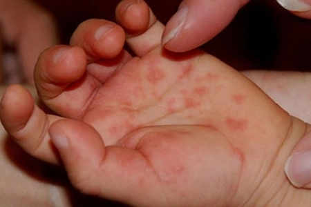 Bệnh tay chân miệng và cách phòng, chống khi vào năm học mới