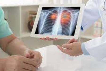 Gánh nặng ung thư phổi tại Việt Nam: Cảnh báo phát hiện muộn và chi phí điều trị lớn