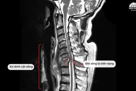 Không thể xoay ngửa cổ vì bệnh hiếm, giáo sư người Nhật sang Việt Nam phẫu thuật thành công