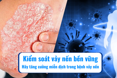 Kiểm soát vảy nến bền vững – Hãy tăng cường miễn dịch