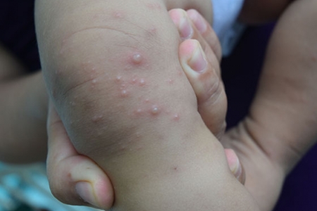 TP. HCM cảnh báo số ca mắc tay chân miệng tăng mạnh