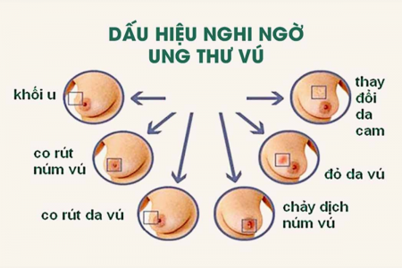 Bước tiến mới trong điều trị ung thư vú tối ưu hóa thời gian và nâng cao chất lượng sống