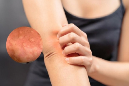 Căng thẳng kéo dài: Nguyên nhân giấu mặt gây mề đay, dị ứng