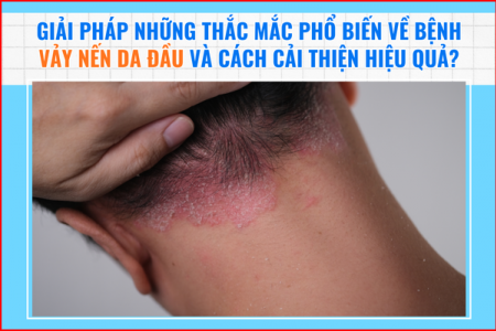 Giải đáp những thắc mắc phổ biến về bệnh vảy nến da đầu và cách cải thiện hiệu quả