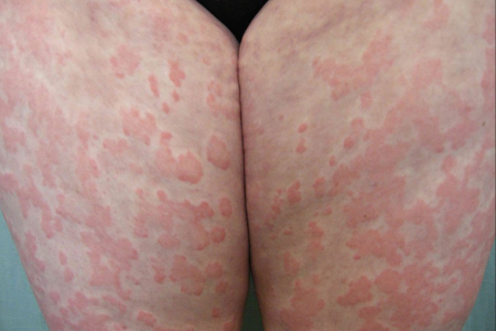 Vì sao mẩn ngứa, mề đay xuất hiện sau khi cơ thể vừa khỏi bệnh?