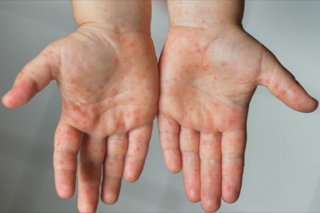 Lào Cai tăng cường phòng, chống bệnh tay chân miệng và các bệnh truyền nhiễm