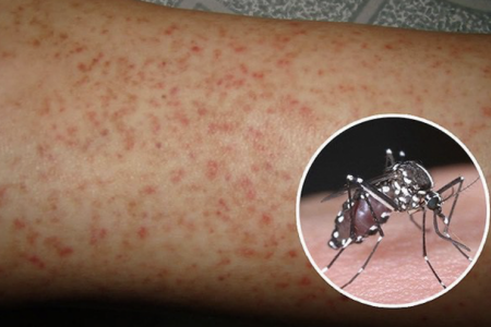 Sốt xuất huyết vào mùa: Cảnh báo nguy cơ bùng phát, cần kiểm soát ngay từ sớm