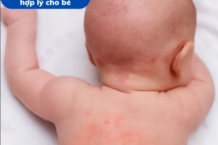 Rôm sảy ở trẻ nhỏ: Hiểu đúng để điều trị hiệu quả