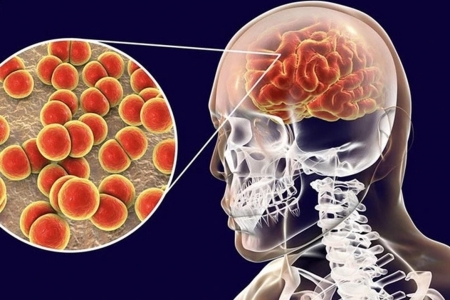 Báo động số ca mắc não mô cầu tăng mạnh, chuyên gia cảnh báo chuỗi di chứng nặng nề
