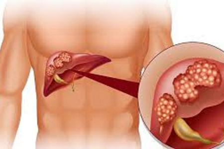 Hiểm họa ung thư gan từ sự lơ là với virus viêm gan B
