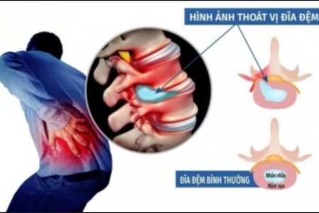 Mổ thoát vị đĩa đệm xong, người bệnh cần làm gì để phục hồi tốt và hạn chế tái phát?