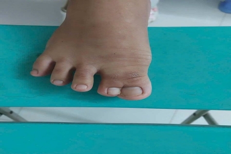 Bệnh viện II Lâm Đồng tách dính ngón chân bẩm sinh hiếm gặp