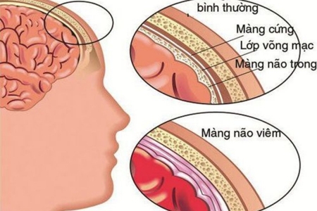 Cảnh giác nguy cơ tử vong nhanh do não mô cầu sau chùm ca bệnh tại trường học