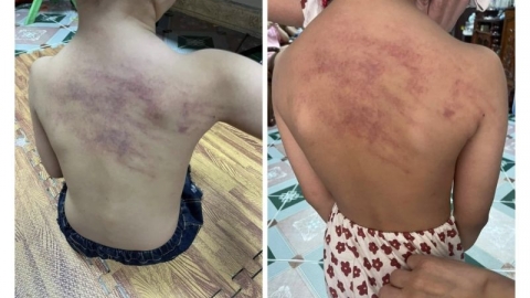 Hải Phòng: Thông tin về vụ việc cháu bé 5 tuổi tại Trường mầm non An Dương bị bầm tím ở vùng lưng