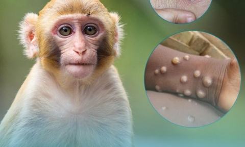 Bệnh nhân đầu tiên mắc đậu mùa khỉ tại Việt Nam là nữ, được phát hiện sau khi về từ Dubai
