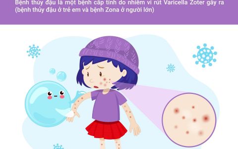 Bệnh thủy đậu và những điều cần biết