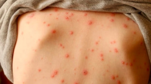 Bệnh thủy đậu mùa cao điểm: Cẩn trọng kẻo nhiễm trùng da