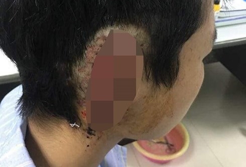 Nghệ An: Nam sinh cắn đứt tai bạn cùng trường nghi bị "ngáo" cỏ Mỹ