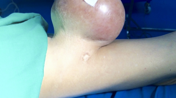 Nghệ An: Phẫu thuật cắt bỏ thành công khối u nặng 2 kg, đeo bám suốt 12 năm trời
