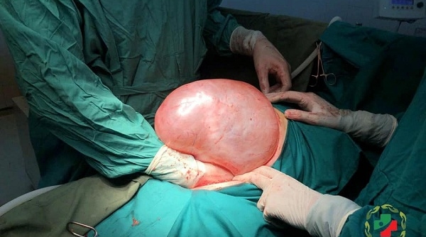 Tuyên Quang: Người phụ nữ có khối u buồng trứng nặng gần 9 kg