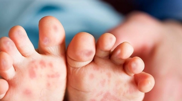 Ninh Bình: Số ca mắc bệnh tay-chân-miệng tăng đột biến