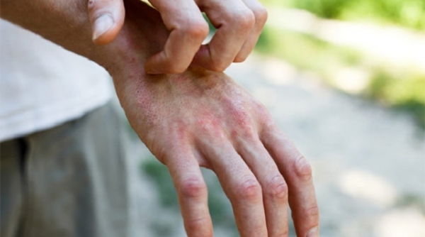 Phát hiện dấu hiệu lạ trên da của nhiều bệnh nhân Covid-19