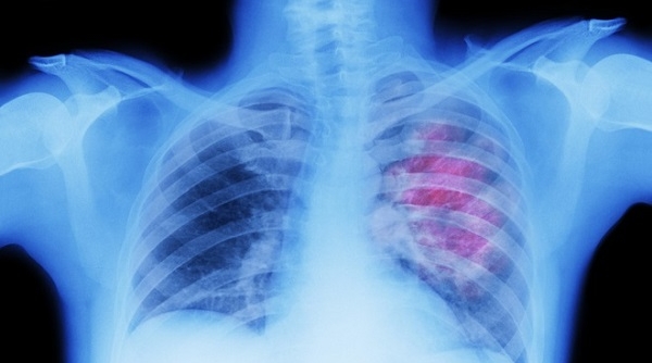 Nghiên cứu về tình trạng thủng phổi ở bệnh nhân mắc Covid-19