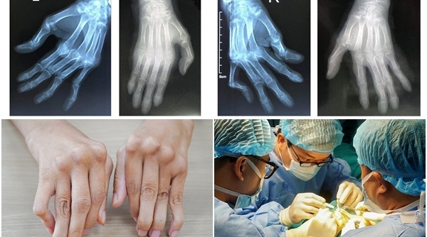 “Hồi sinh” đôi bàn tay bị biến dạng do viêm khớp dạng thấp