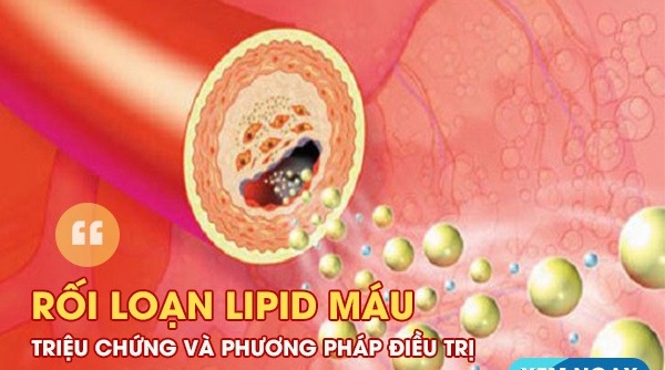 Rối loạn lipid máu – Triệu chứng và phương pháp điều trị
