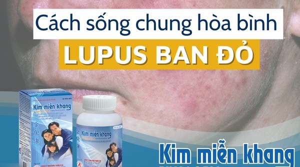 Lupus ban đỏ dạng đĩa và cách chung sống hòa bình với bệnh nhờ Kim Miễn Khang