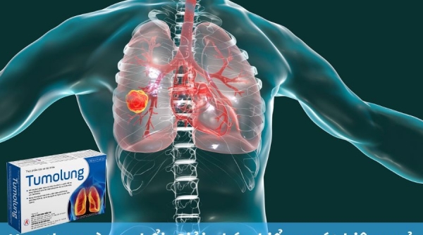 Ung thư màng phổi: Phát hiện sớm và kiểm soát hiệu quả nhờ Tumolung