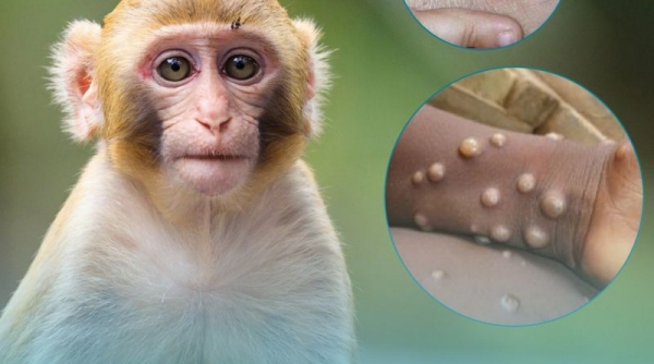Bệnh nhân đầu tiên mắc đậu mùa khỉ tại Việt Nam là nữ, được phát hiện sau khi về từ Dubai