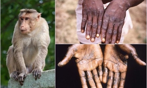 Bộ Y tế yêu cầu không để bùng phát dịch đậu mùa khỉ, hạn chế lây nhiễm và tử vong