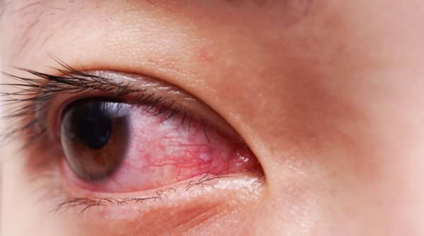 Thanh Hóa tăng cường công tác phòng chống bệnh đau mắt đỏ